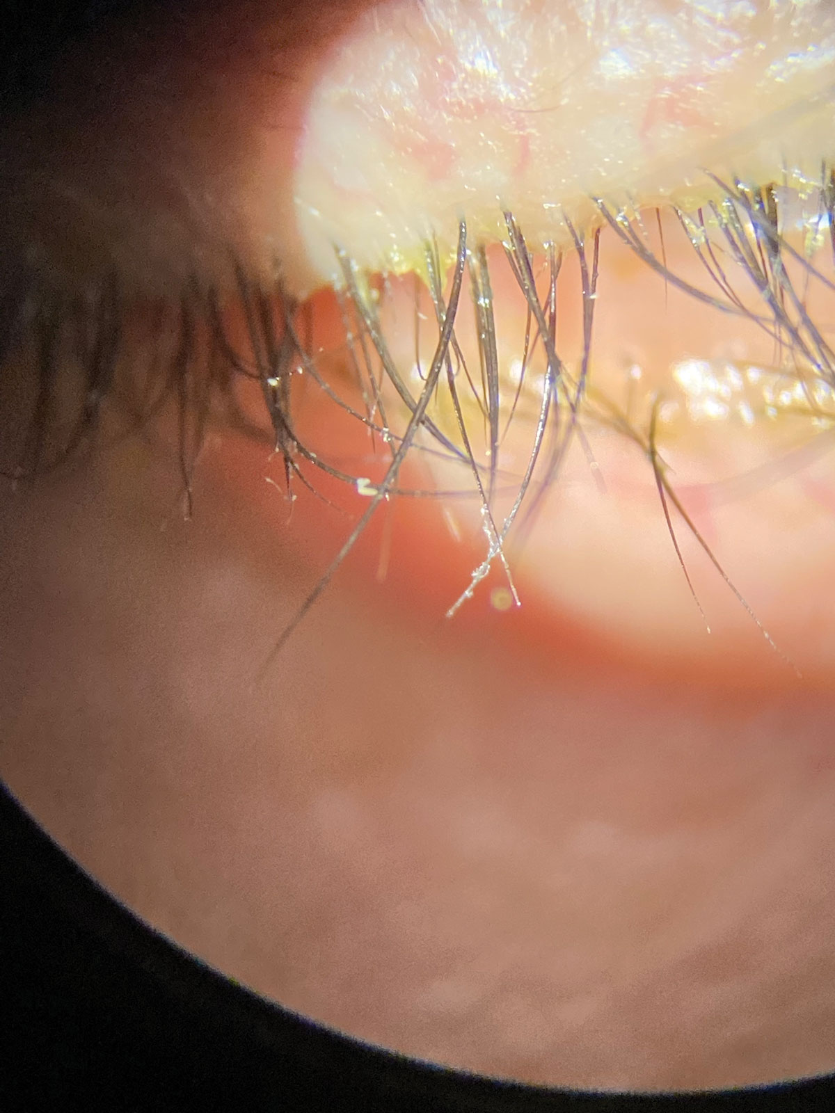 Collarettes are pathognomonic for Demodex blepharitis