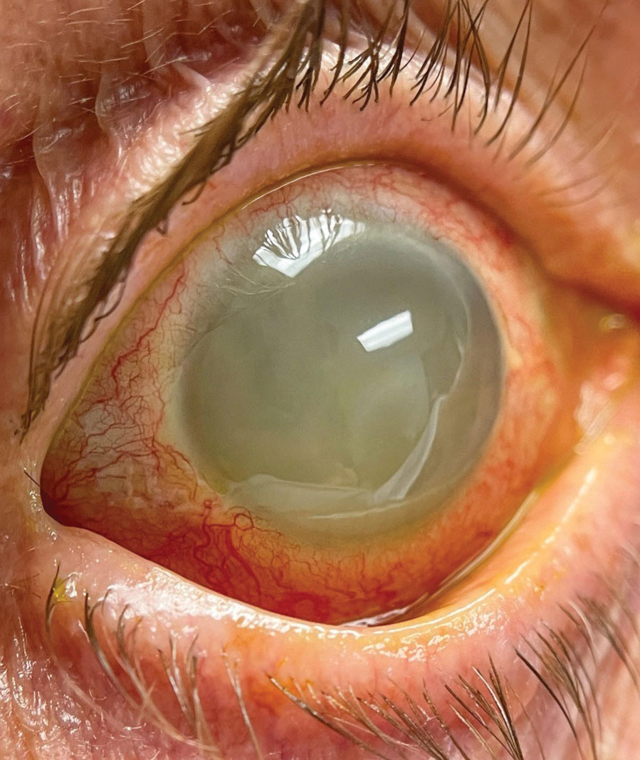 Fig. 2. A magnified view of the right eye’s anterior segment.