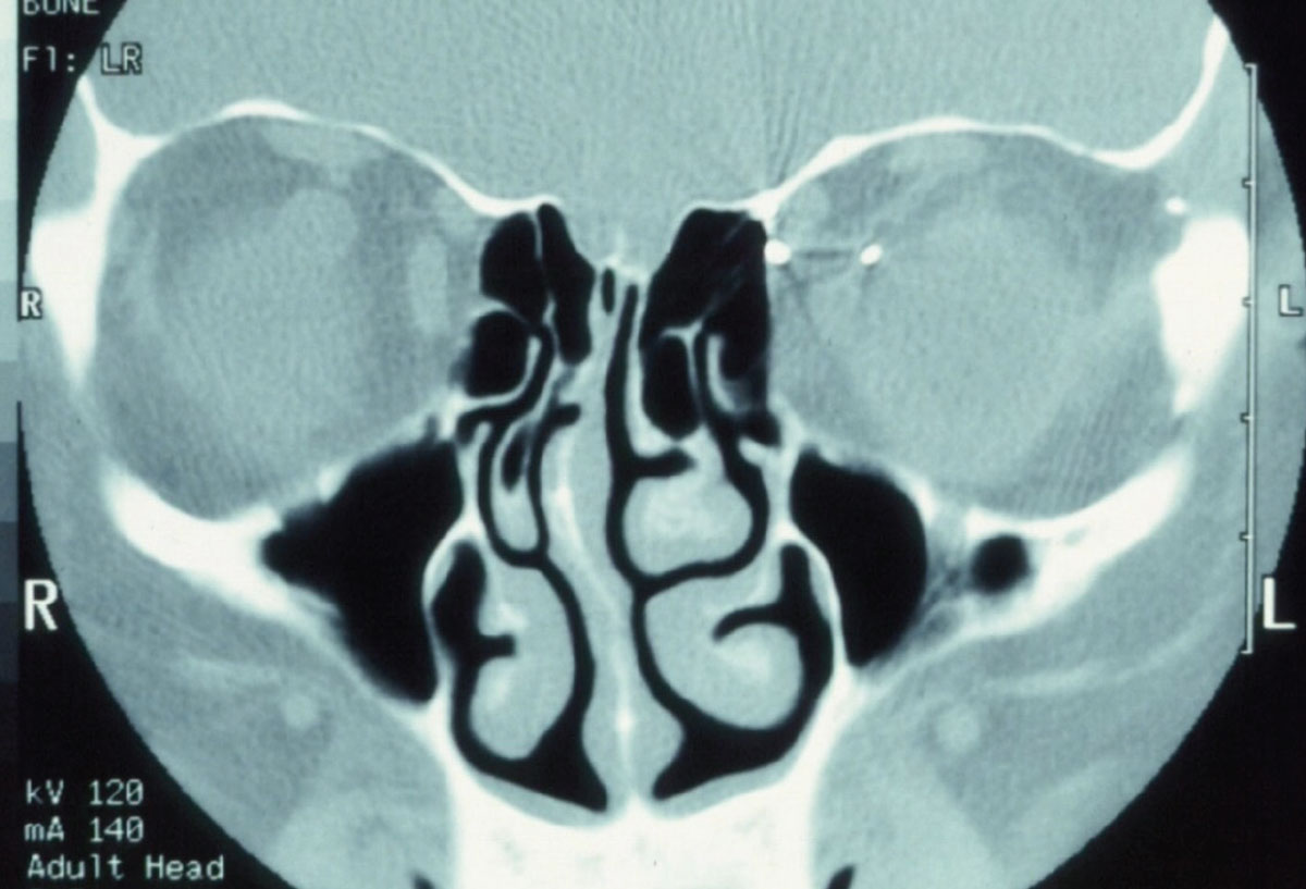 Fig. 2. Pictured here is a metallic foreign body in the left orbit. Consider that MRI physics employs a powerful magnet to obtain images. In cases where a metallic foreign body is suspected in the orbit or globe, CT imaging is warranted so as to not violently dislodge the foreign body.