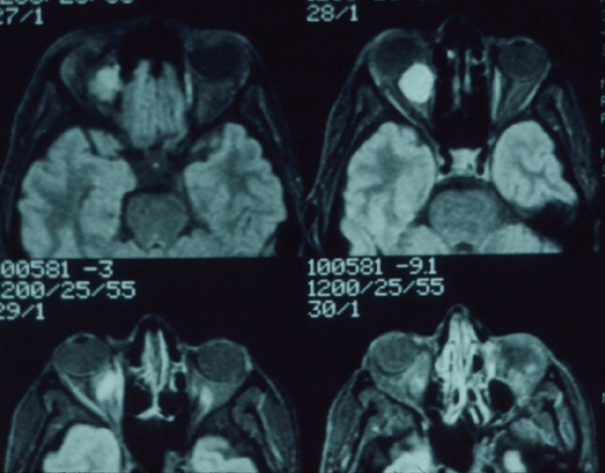 Fig. 3. Note the mass in the retrobulbar space of the right orbit.