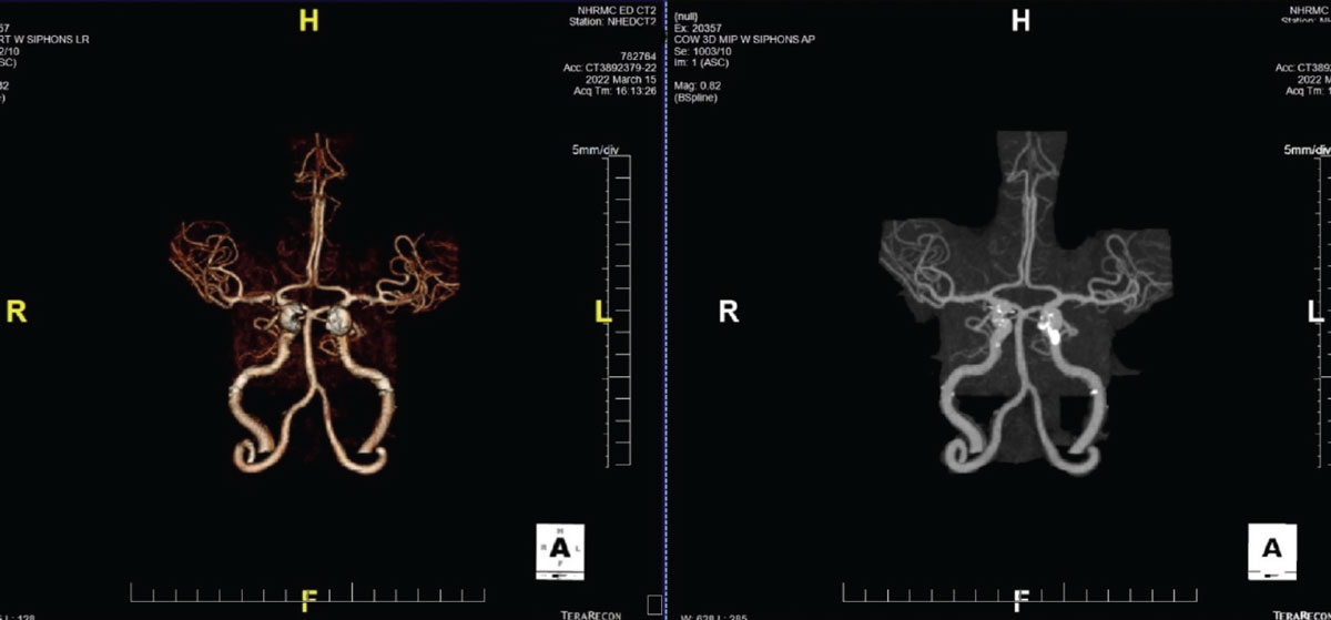 Fig. 4. A CTA demonstrating significant plaque formation in a patient with transient visual obscurations. Note the calcification of the L>R internal carotid arteries.