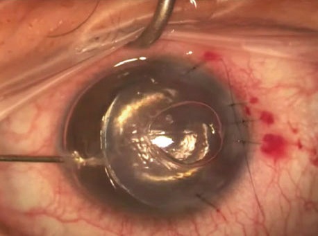 DSAEK patients in this study experienced a clinically insignificant 0.2D myopic shift over time, which confirms that the grafts maintained stability and shape long-term.