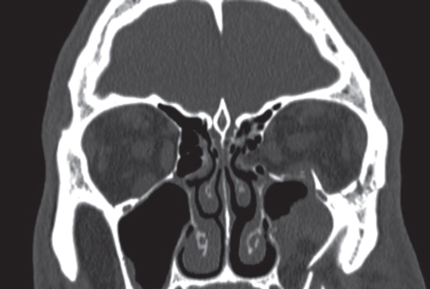 The majority of ocular injuries found in cases of intimate partner violence were orbital fractures, as seen here, followed by contusion of the eyelid and periocular eyelid and injury of the eye and orbit.