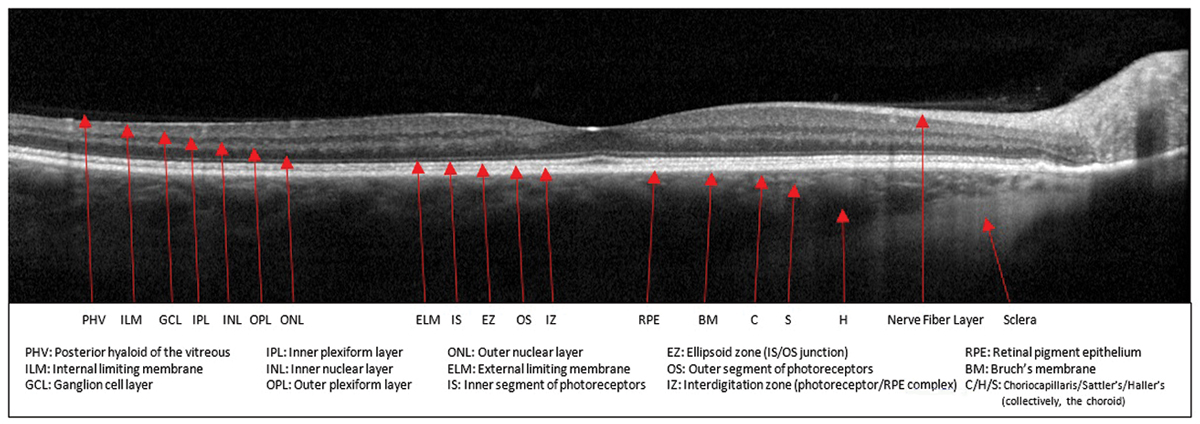 Monitoring the foveal ONL thickness during early anti-VEGF treatment can give information about the visual outcomes in type 1 CNV.