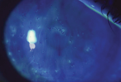 Clinicians shouldn’t be too quick to rule out stromal invovement in Thygeson’s superficial punctate keratitis. Though it’s true that the epithelium is the structure primarily affected, stromal inflammation and scarring can also accompany it.