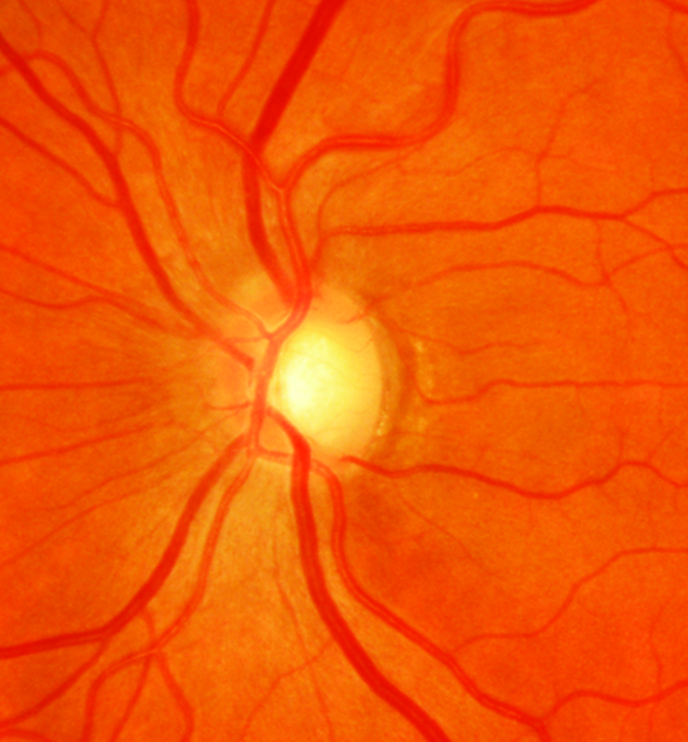 Those with the strongest genetic correlation to known alleles at work in glaucoma had a 3.3-times greater risk of starting IOP-lowering therapy within five years compared with patients showing the weakest genetic footprint for the disease.