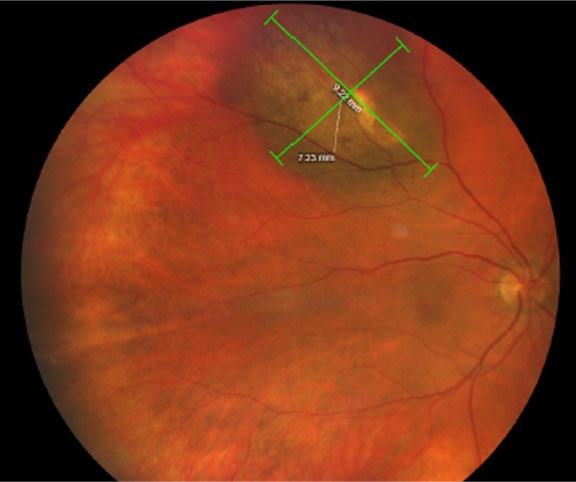 What’s known as ‘the obesity paradox’ could apply in uveal melanoma, as those who were obese had a lower risk of developing metastases and consequently dying than those with lower BMIs.