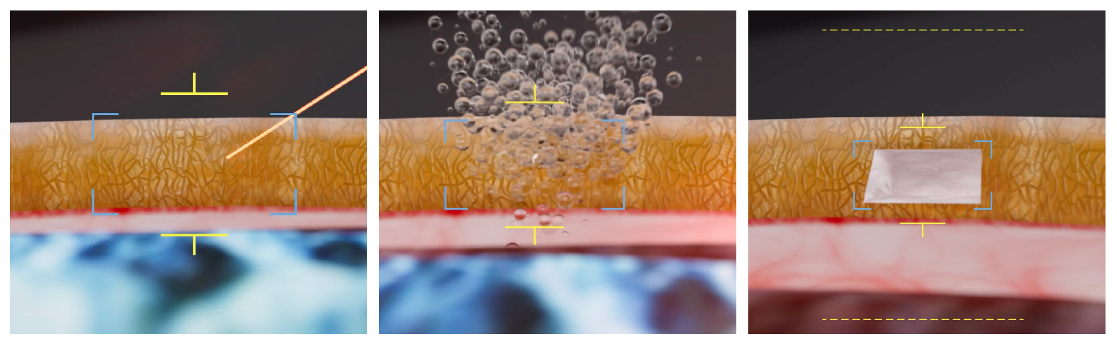 No serious adverse events came from FLIGHT, which could be an alternative to MIGS for patients with glaucoma.