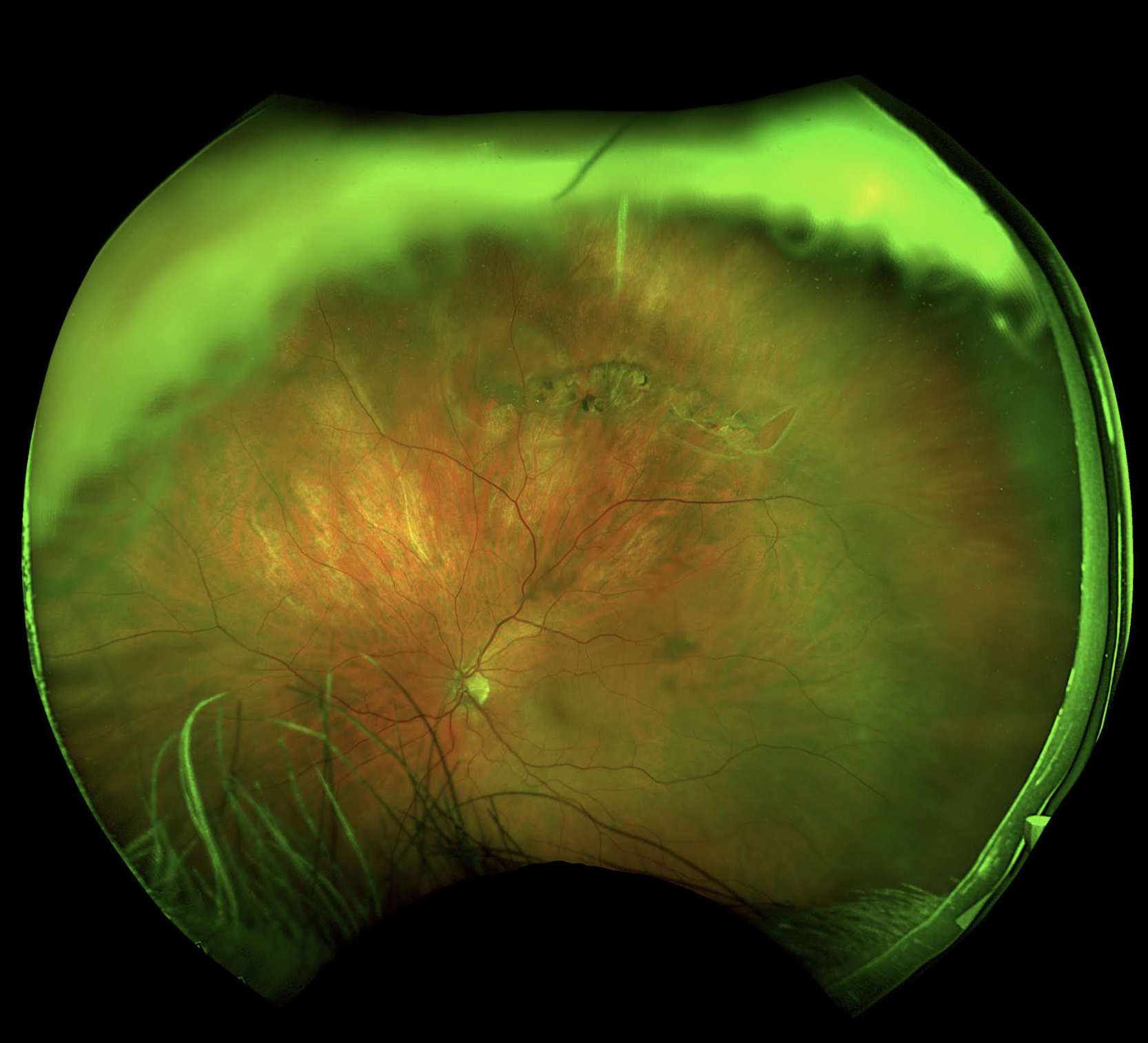 A double horseshoe tear in an area of lattice from a PVD. The tear was not present at the first visit but instead found at the one-month follow-up. 