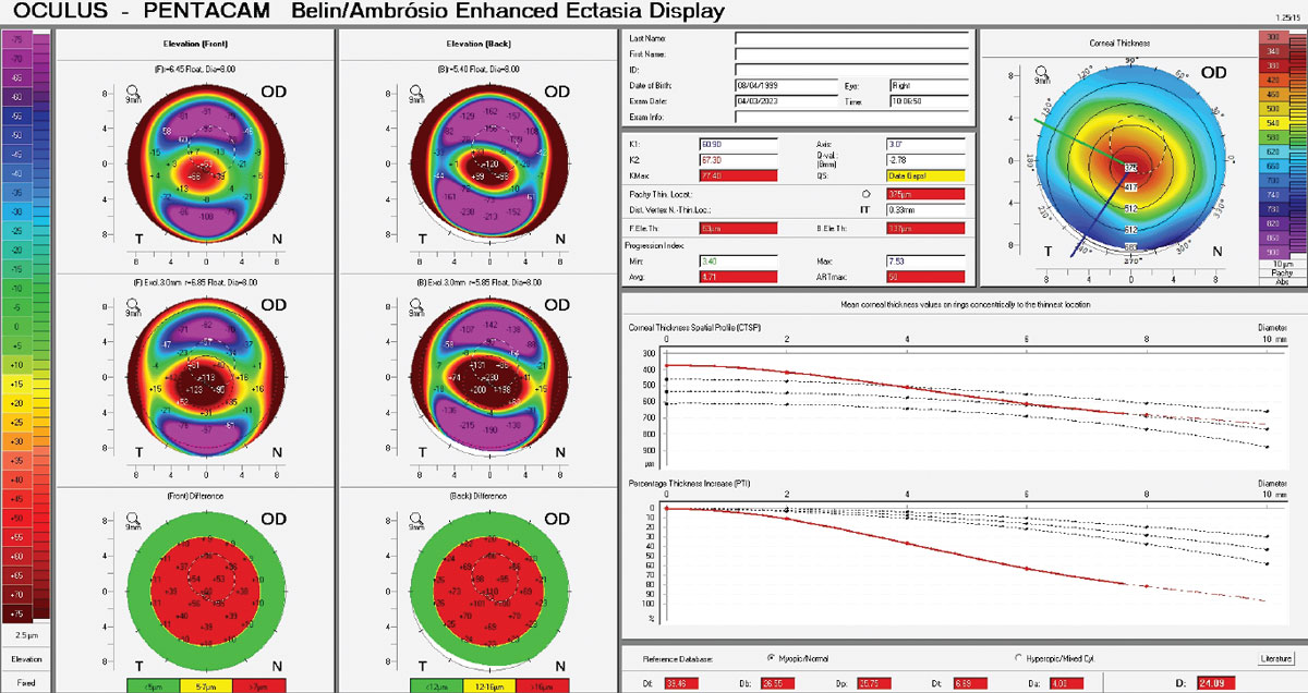 Corneal tomography is integral to guiding treatment decisions in keratoconus, especially for thinner corneas that are sensitive to certain interventions, such as epi-off CXL. 