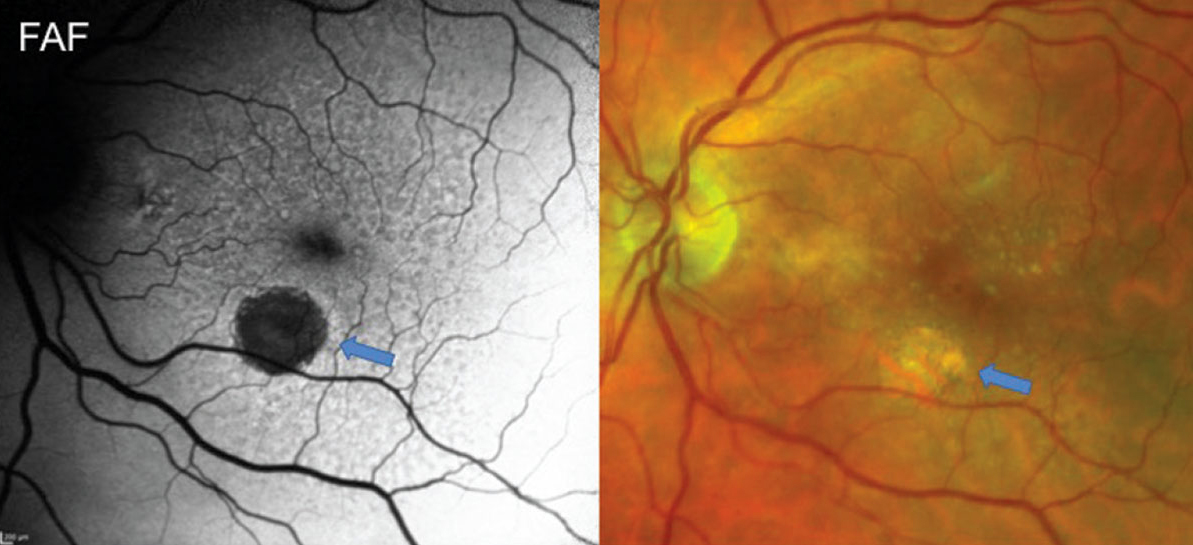 Geographic atrophy can cause meaningful disease burden by visual acuity, conversion to wet AMD and central subfield thickness measures. 