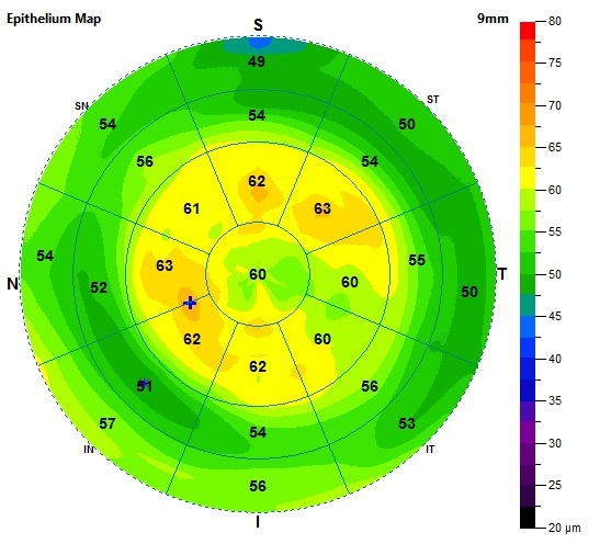 If a patient’s eye has both superior corneal epithelial thickness <45µm and Schirmer’s test result <10mm, they are five-times more likely to have antibody-positive bloodwork and associated visual compromise.