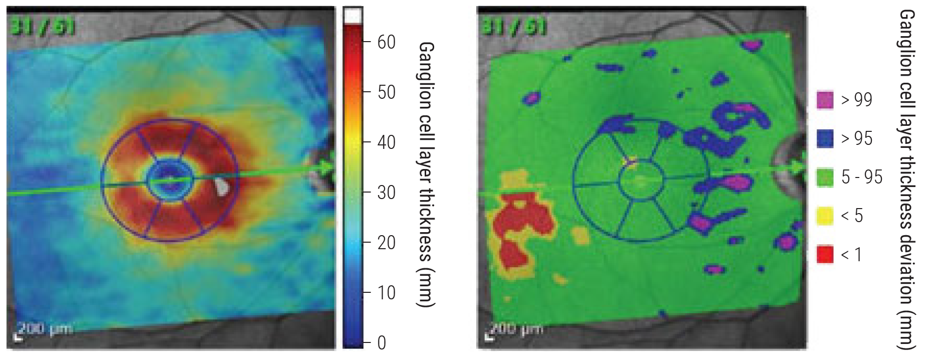 Glaucomatous visual field loss rates correlate better with rates of GCL thinning than with rates of RNFL thinning.