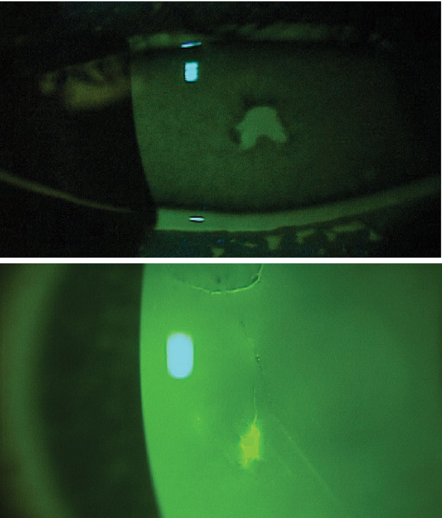 Managing Episodes of Corneal Trauma