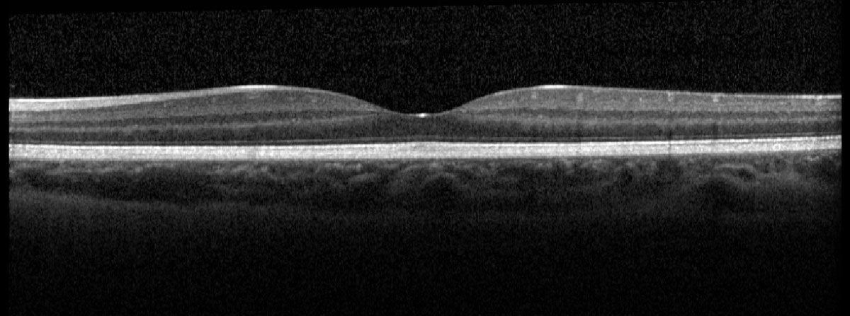 Fig. 4. Heidelberg OCT of the left macula.