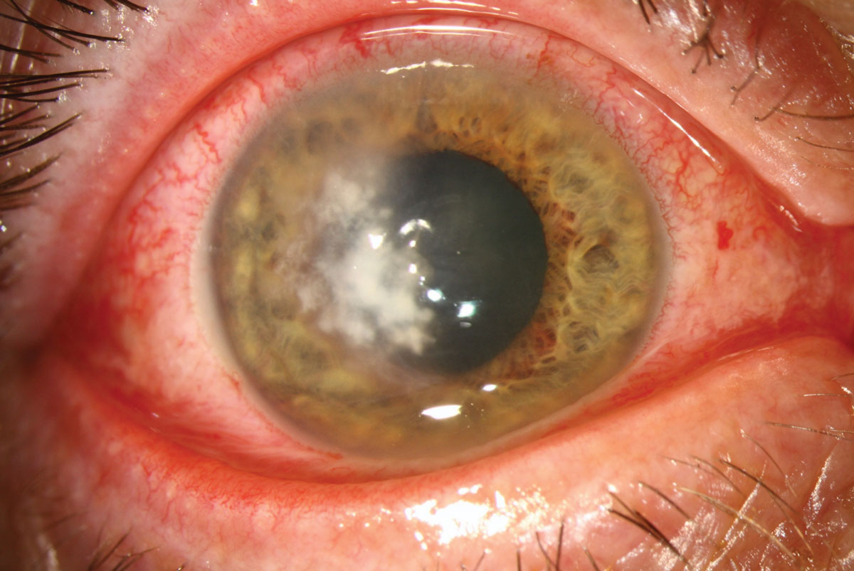 Fungal lesions tend to have dry, elevated infiltrates with feathery margins. This patient has a Fusarium ulcer.