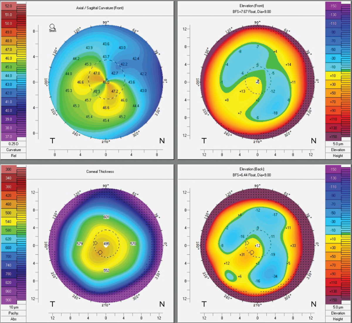 Keratoconus: What Surprises the Experts?