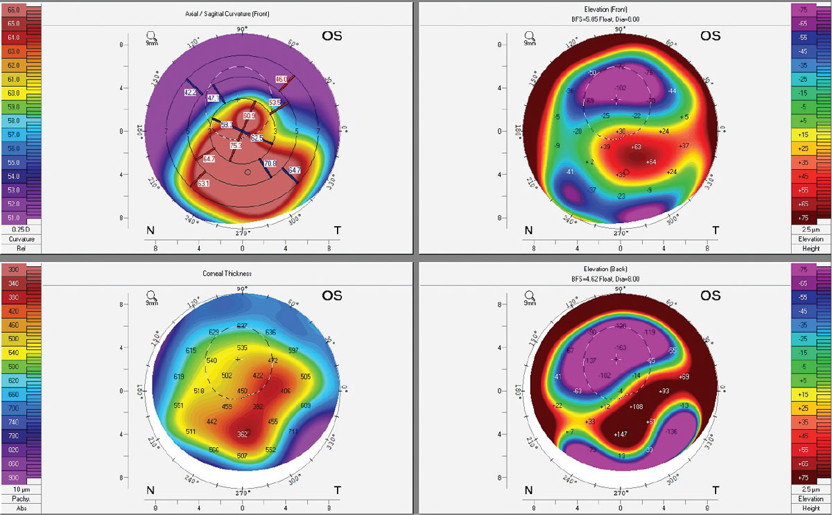 Corneal topography of an advanced keratoconus patient with an Intacs implant and corneal scarring. Note the extreme elevation differences of the back surface of the cornea, corresponding to the thinnest pachymetry areas. For additional diagnostic imaging on this patient, see page 66.