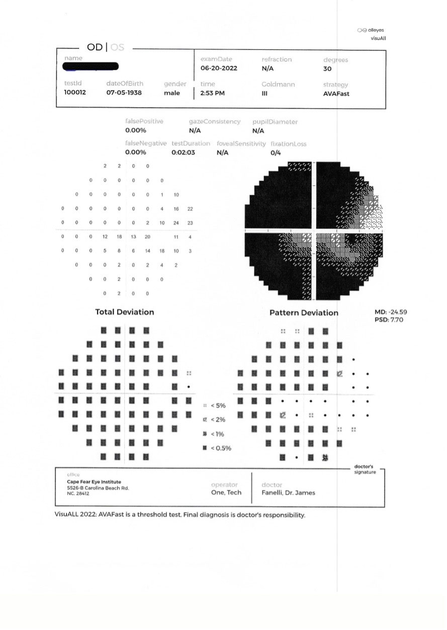 A 30-2 threshold field following loss of control of the right eye in June 2022. This was the second VF since re-evaluation. 