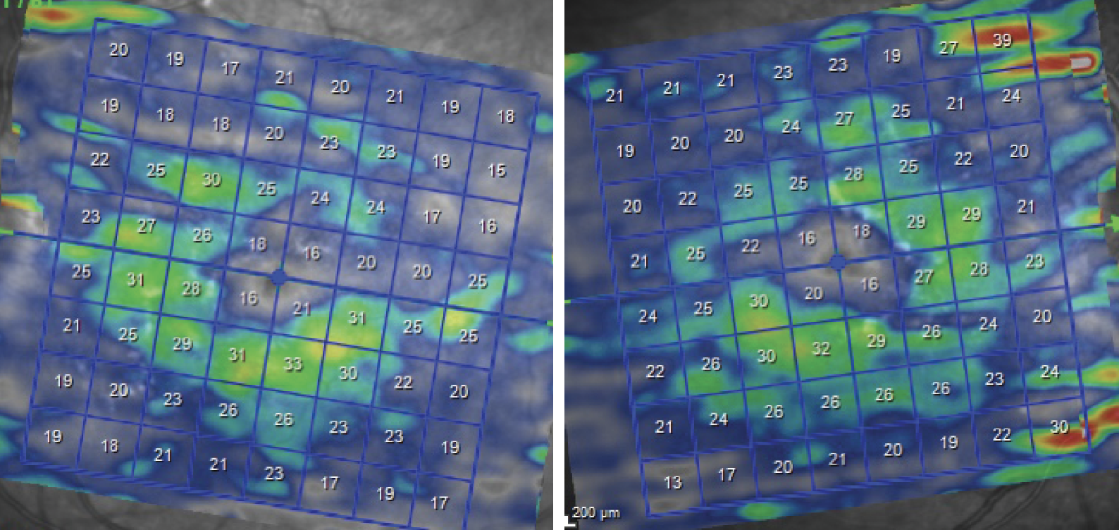 Heidelberg OCT of the ganglion cell layer shows extreme thinning in both eyes.