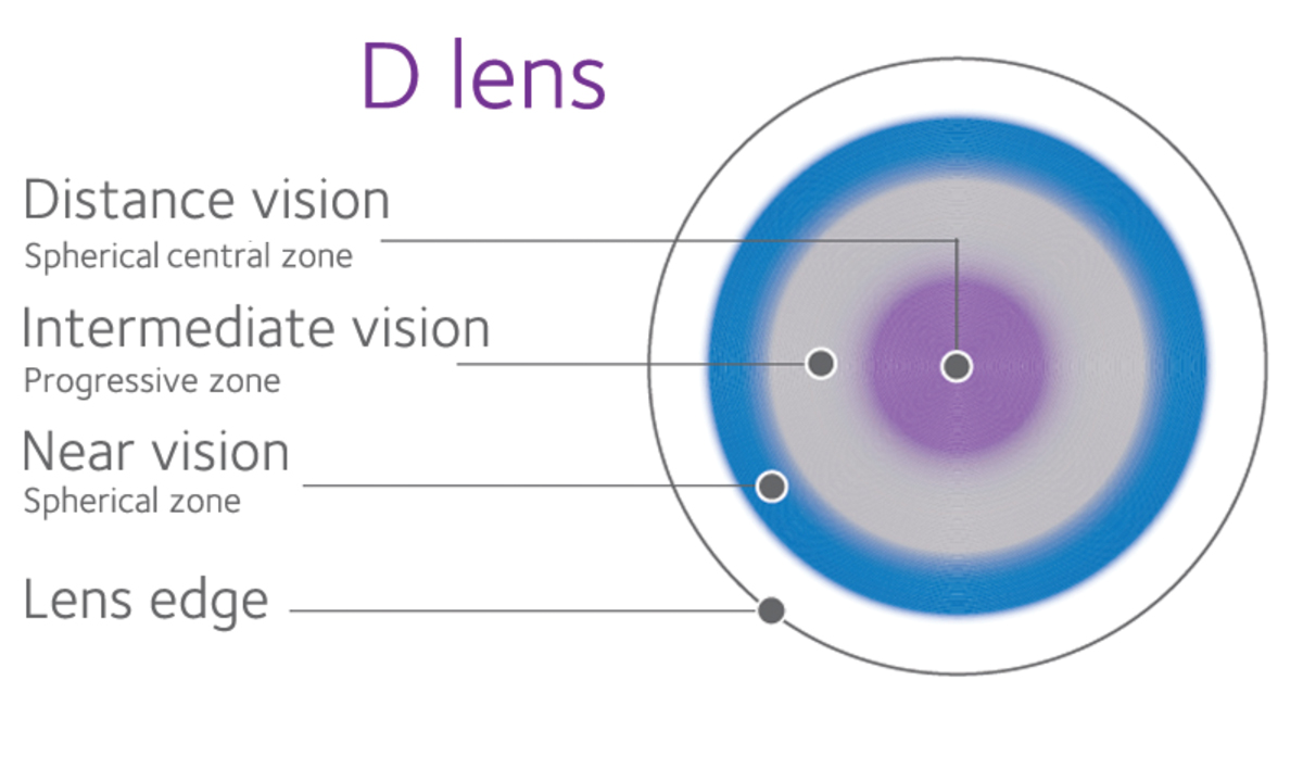 Results from the BLINK Study suggest that treatment effect for myopia control is similar for all rates of progression in children and that soft multifocal contact lenses don’t affect comfort, focus or how well the two eyes work together.