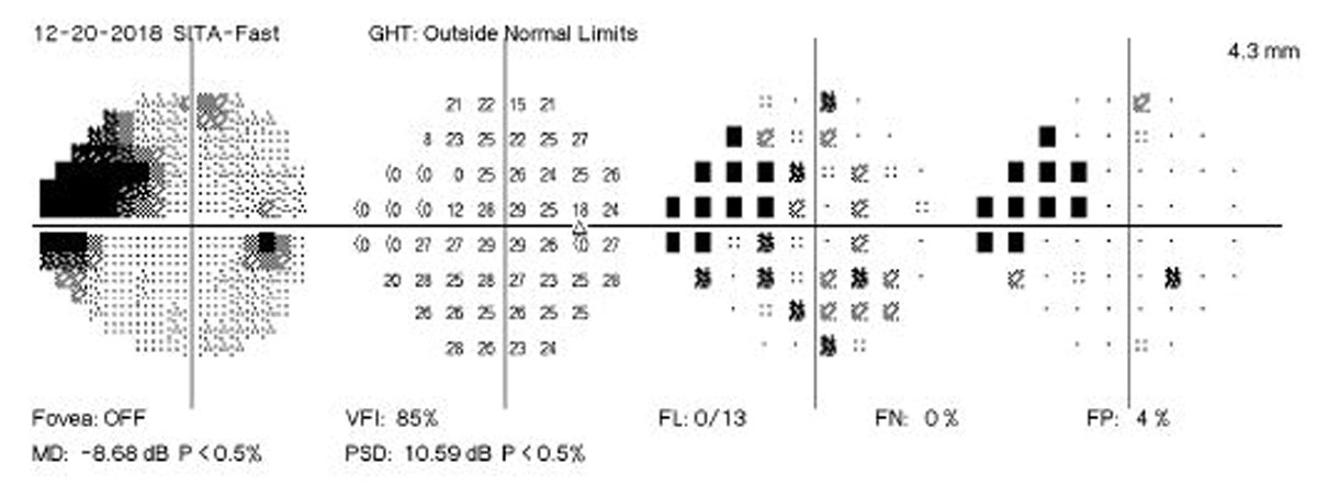 : Glaucoma patients who undergo delayed treatment may not see many visual function consequences.