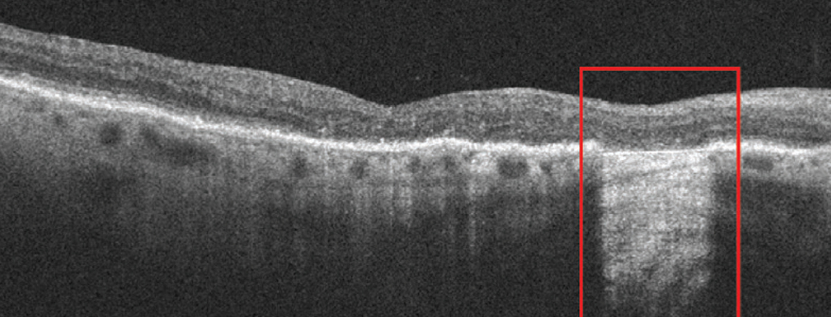 Early cRORA lesions have a slower growth rate in comparison to atrophic lesions in advanced disease stages of GA.