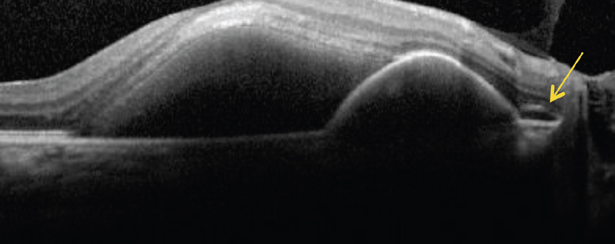 Polypoidal lesions seen with PCV seem to regress more with combination intravitreal anti-VEGF and photodynamic therapies.