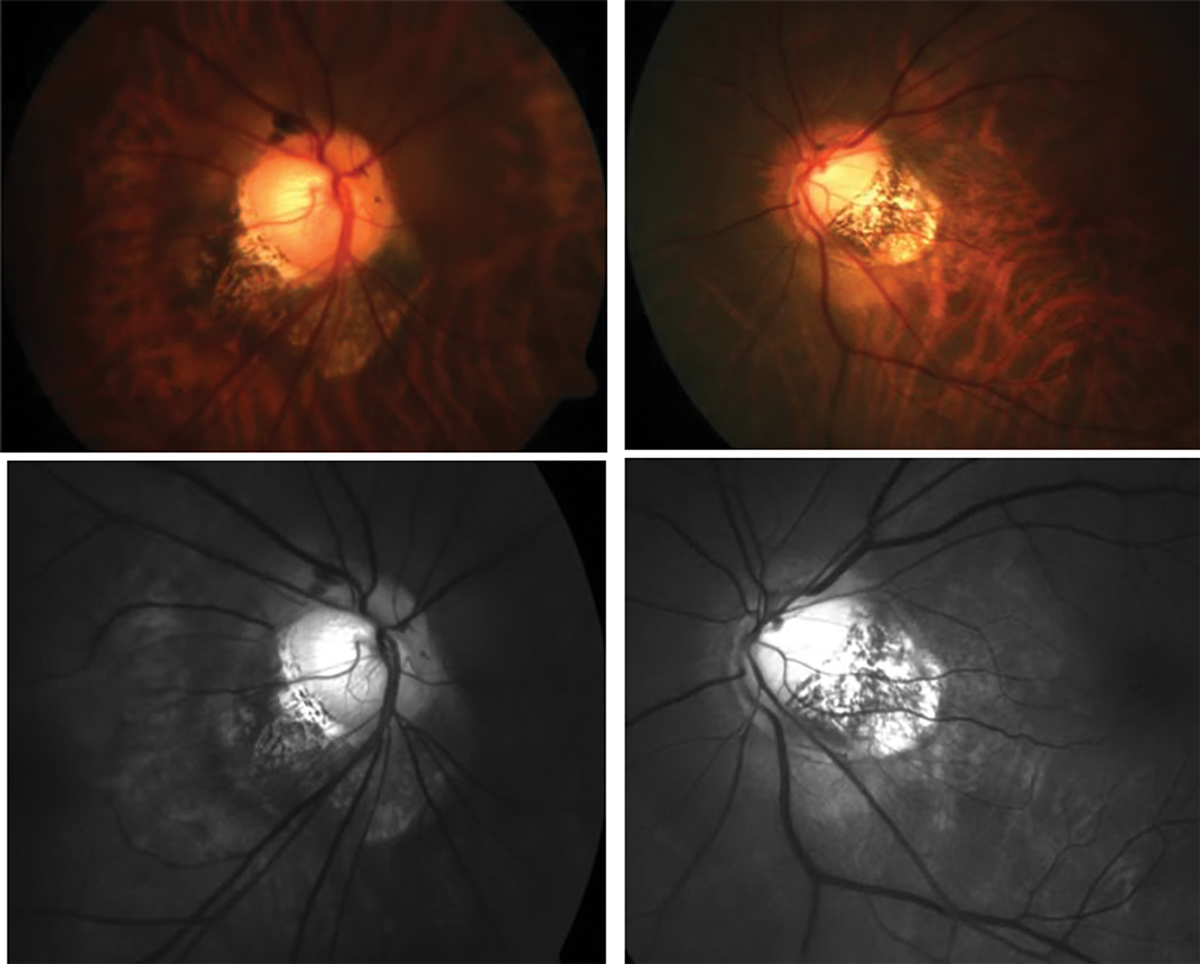 Gaze-induced ONH deformations following eye movements are greater in high myopic eyes.