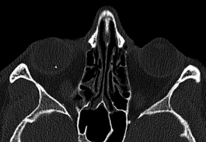 CT of the orbits with 1mm cuts was performed to rule out foreign material that missed on exam. A small, hyperdense body can be seen within the right globe.