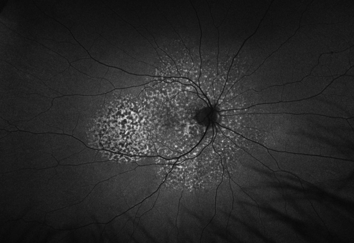 Fig. 3. Optos FAF of the right eye.