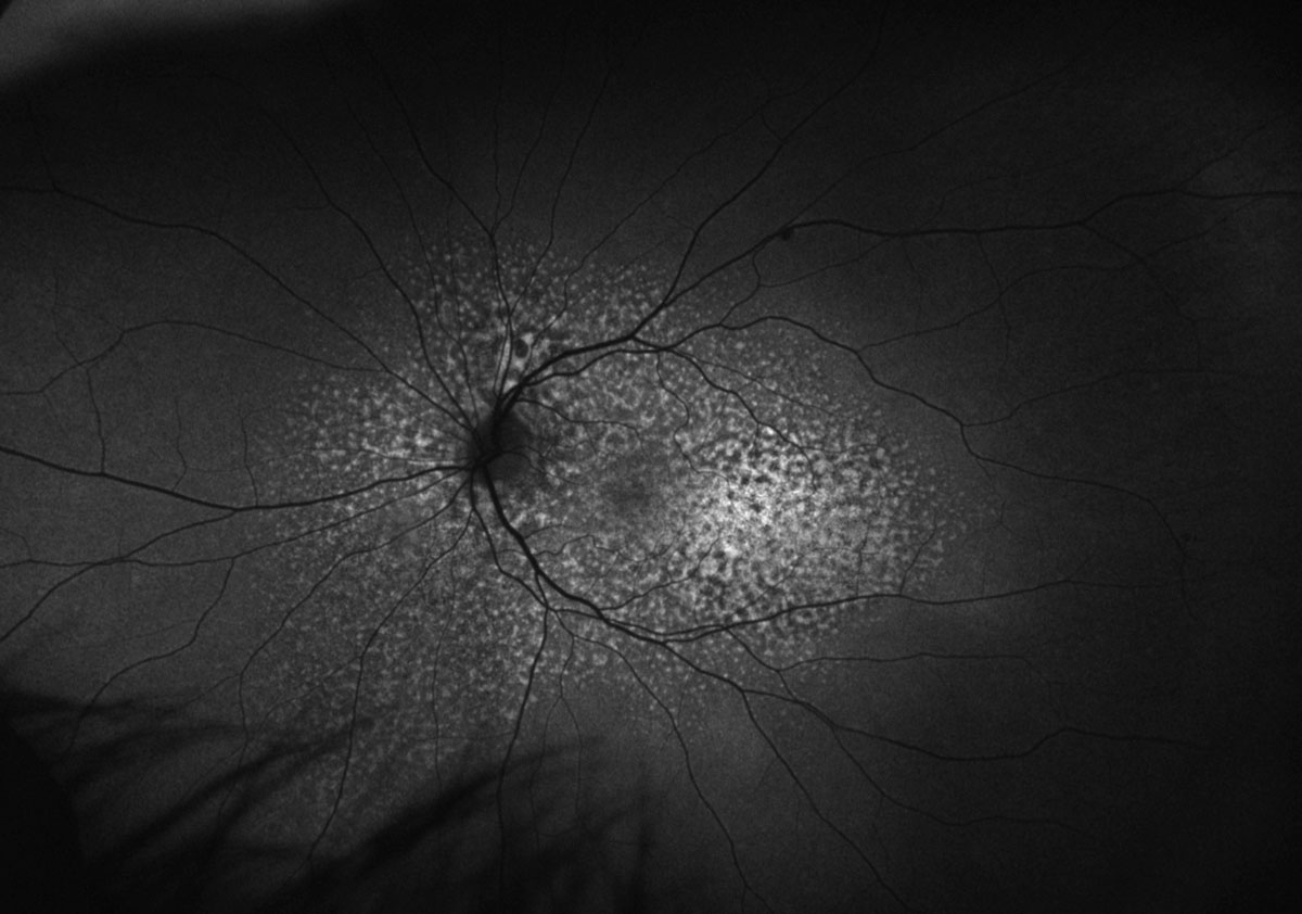 Fig. 4. Optos FAF of the left eye.