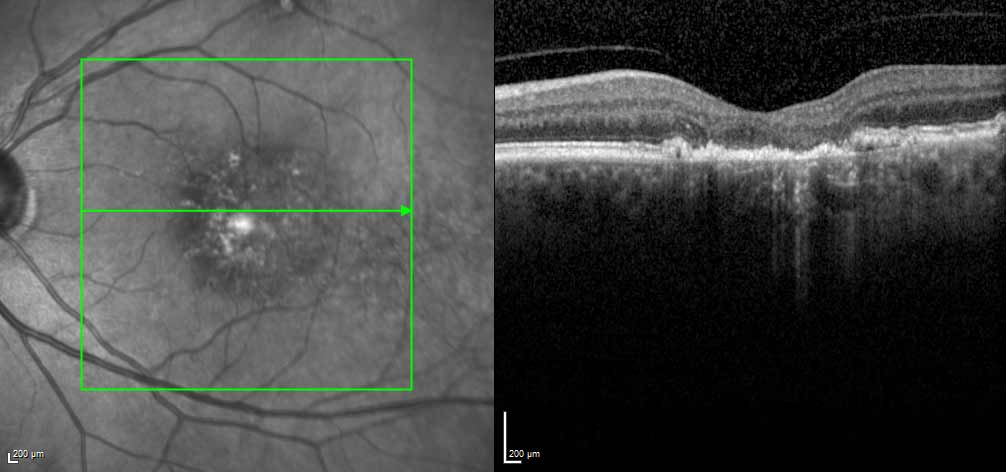 Diffuse loss of photoreceptors and RPE can be useful to detect GA.