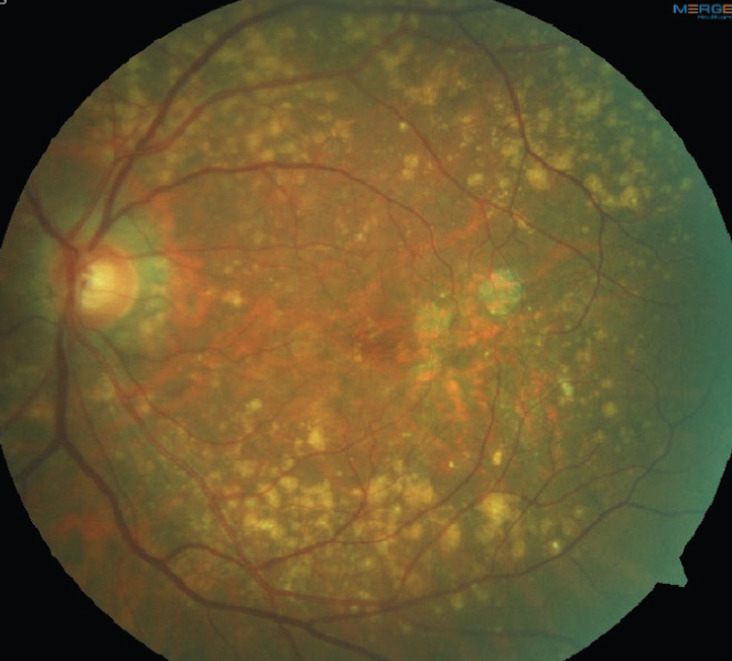 Clinical signs like drusen arise from lipid dysfunction and have different systemic associations than subretinal drusenoid deposits or other lipid-derived entities.