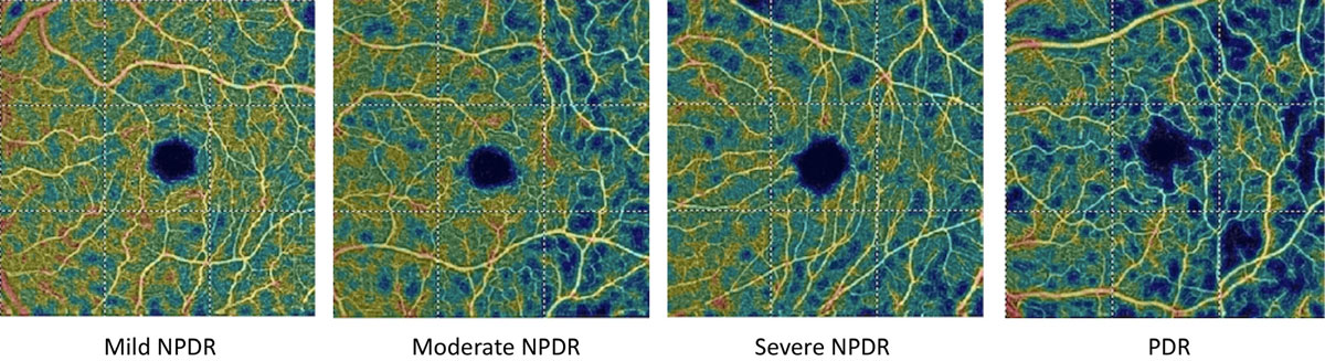 In this study, no OCT or OCT-A metrics were associated with new DR development; however, some were able to predict disease progression.