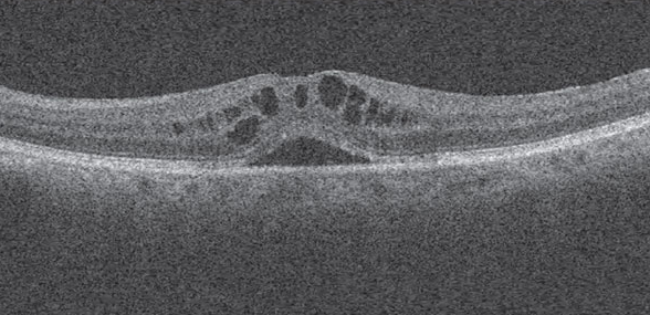 New data from an IRIS Registry analysis suggests age, smoking, Medicaid insurance, non-white race and underlying retinal pathology contributes to poorer visual outcomes.