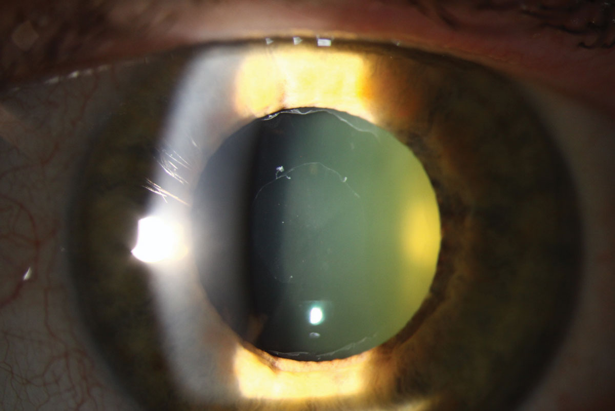 Mini-Mental State Examination scores were lower in PEX patients with glaucoma, indicative of greater Alzheimer’s severity. 