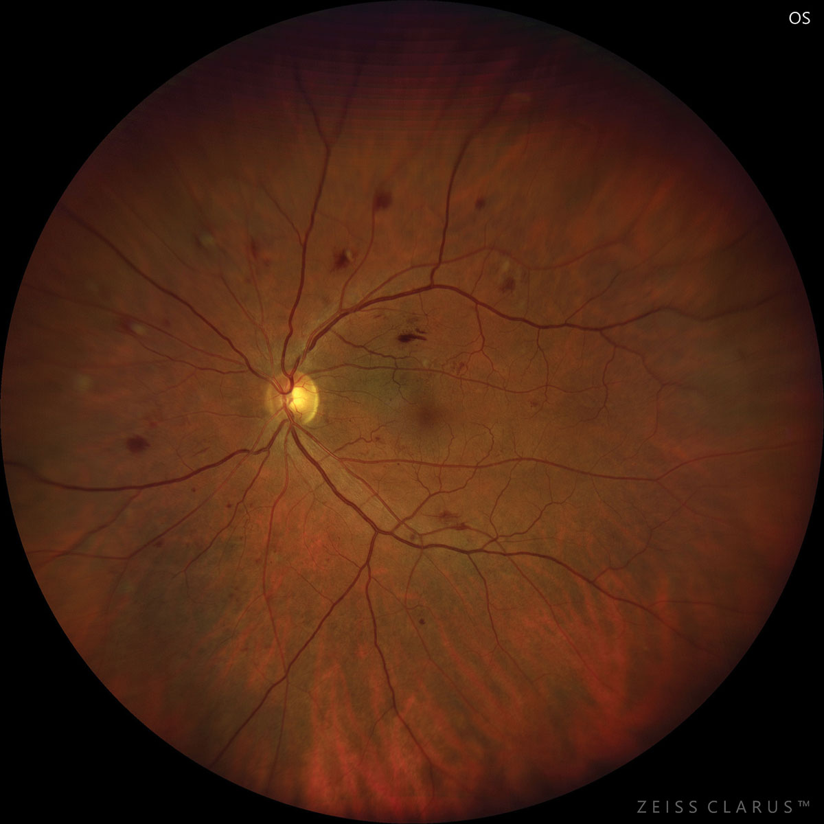 Underuse of eye care in patients with greater social burdens was equal in its effects for type 1 and type 2 diabetes patients. 