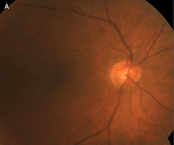 Focal rim thinning (seen here at 7 o’clock) was associated with female sex and higher pattern standard deviation scores.