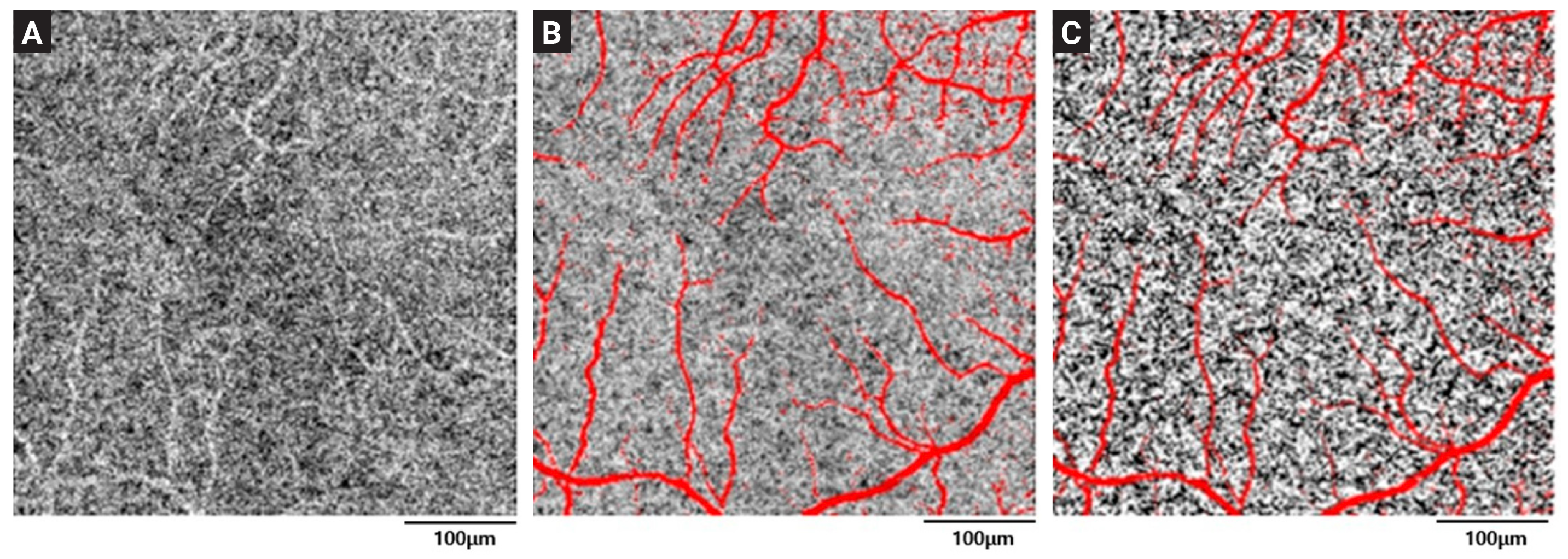 Flow voids are areas where blood flow signal becomes lower. In other words, the flow void refers to the non-white part of a black/white binary image, which can be considered as the non-flow part of the choriocapillaris. Image shows (A) a choriocapillaris angiogram,  (B) Projection mask (red pixels) derived from the superficial and deep angiograms superimposed on the field, and (C) Binarization of choriocapillaris layer to reveal flow dynamics.