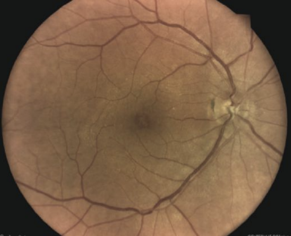 Macular pseudohole.