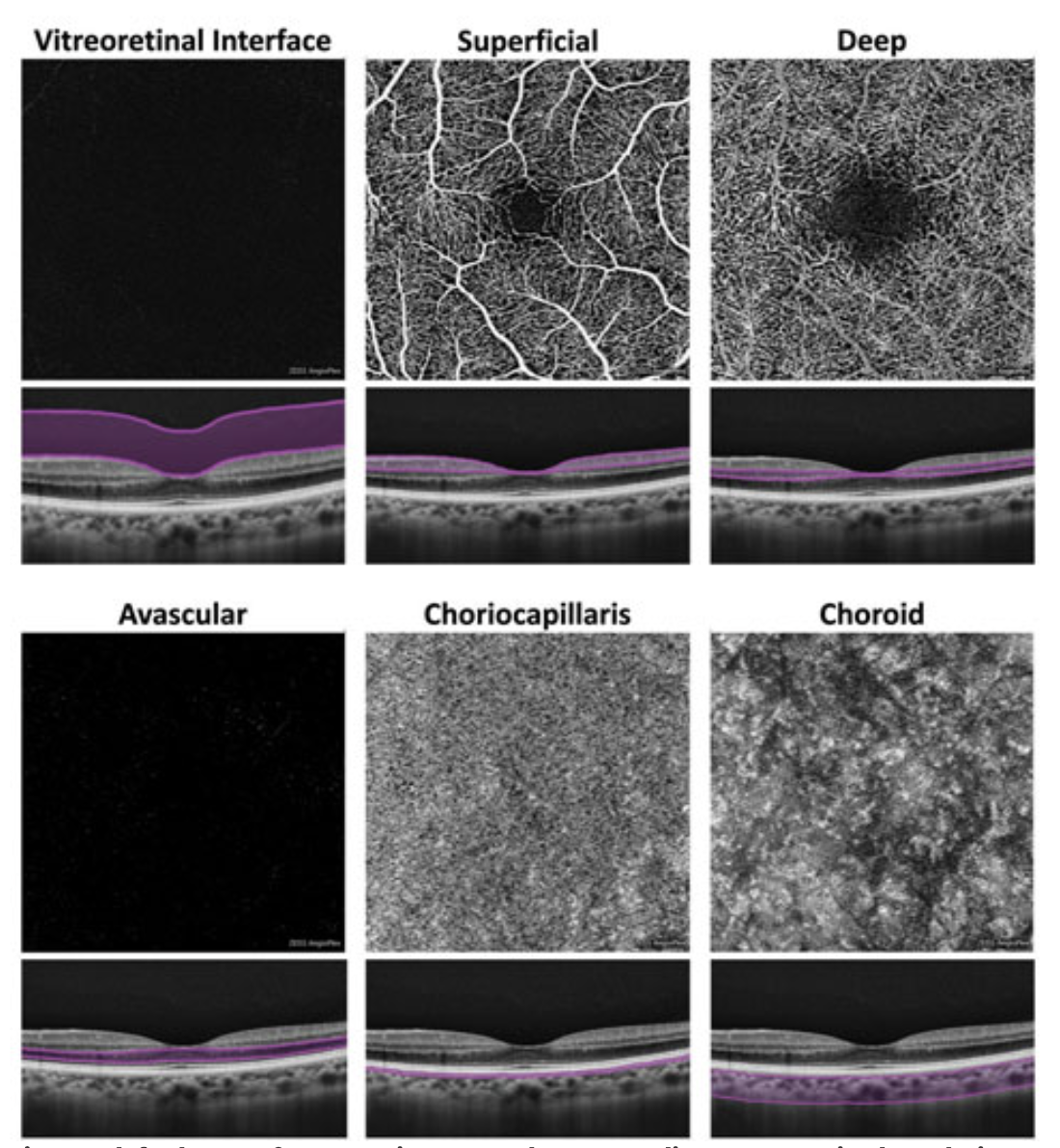 Accumulation of beta amyloid macroscopically induces a wide range of vascular abnormalities, as previous research suggests, including vascular attenuation, vessel tortuosity, narrowed veins, reduced branching complexity and increased width of vessels.