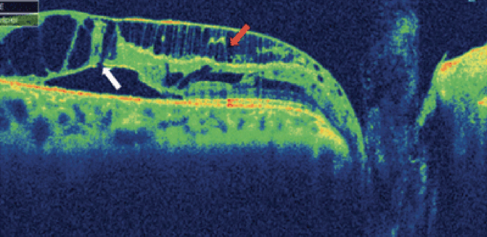 Peripapillary, Macular Retinoschisis Can Develop Without Visible Optic ...