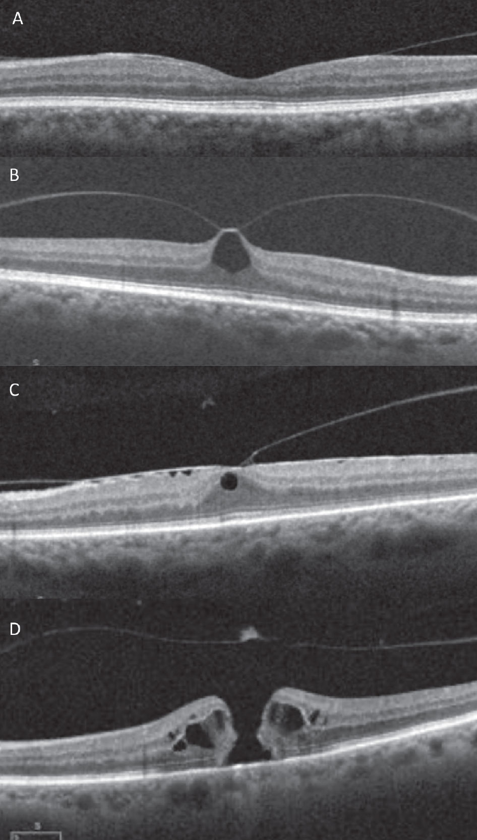 Fig. 3. SD-OCT images of the vitreomacular interface. (A) VMA, (B) focal VMT with pseudocyst, (C) broad VMT with ERM, (D) medium full thickness macular hole with operculum and posterior hyaloid release.