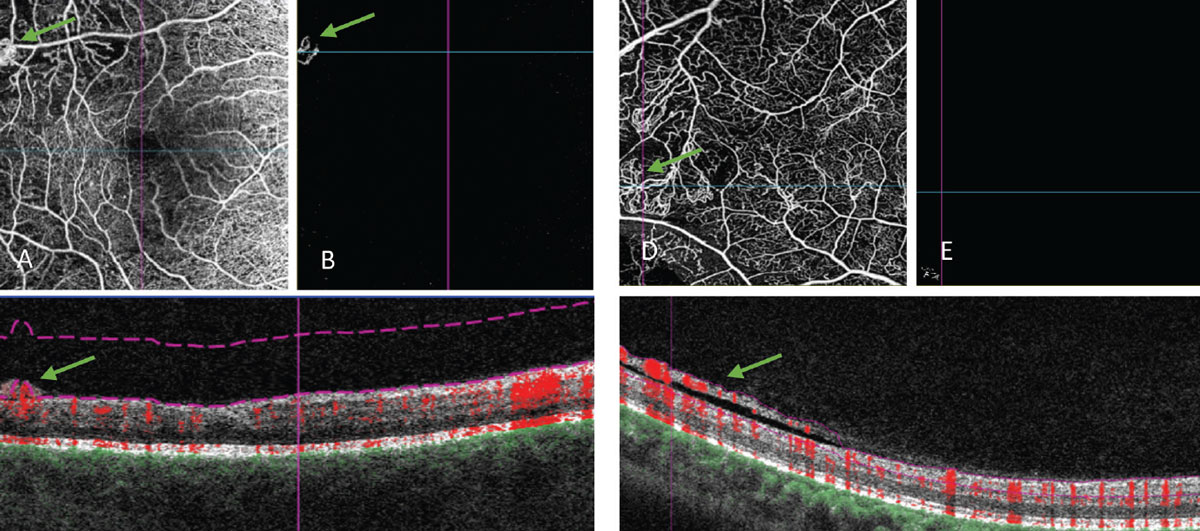 Fig. 5. OCT angiography of retinal neovascularization. (A) An angiogram of the retinal vessels. (B) VRI slab that segments out the vitreoretinal interface. This scan should normally be black, as this area is void of blood vessels in a healthy individual. (C) Corresponding B-scan, where you can see the abnormal vessels fully protruding past the posterior hyaloid and into the vitreous. The flow overlay tool shows red coloring within these vessels corresponding to active movement or flow within. (D, E and F) Another OCT-A of flat neovascularization that extends along the posterior vitreous surface. (F) Because of how it is improperly segmented in the B-scan (purple lines), the abnormal blood vessels do not show in the VRI slab.