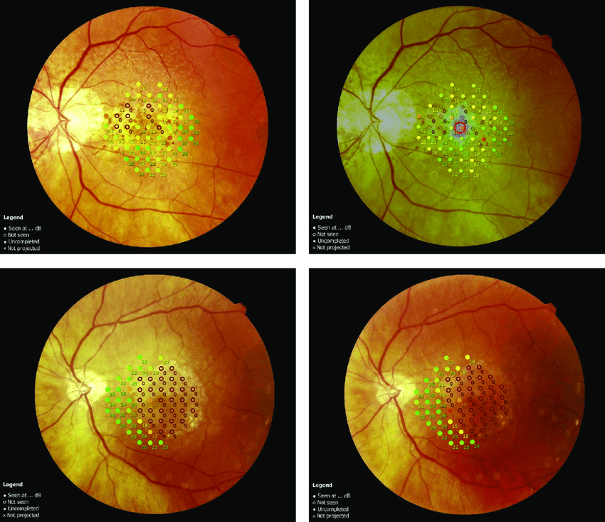 If the area adjacent to absolute scotoma is destined to atrophy, the parameter of responding sensitivity may provide the best information on remaining macular response and visual function over time.