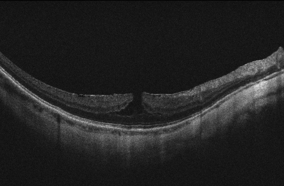 Fig 2. OCT scan of the top (A) and bottom (B) macula showing ERM, myopic foveoschisis with associated lamellar macular hole OS>OD and thin choroid.