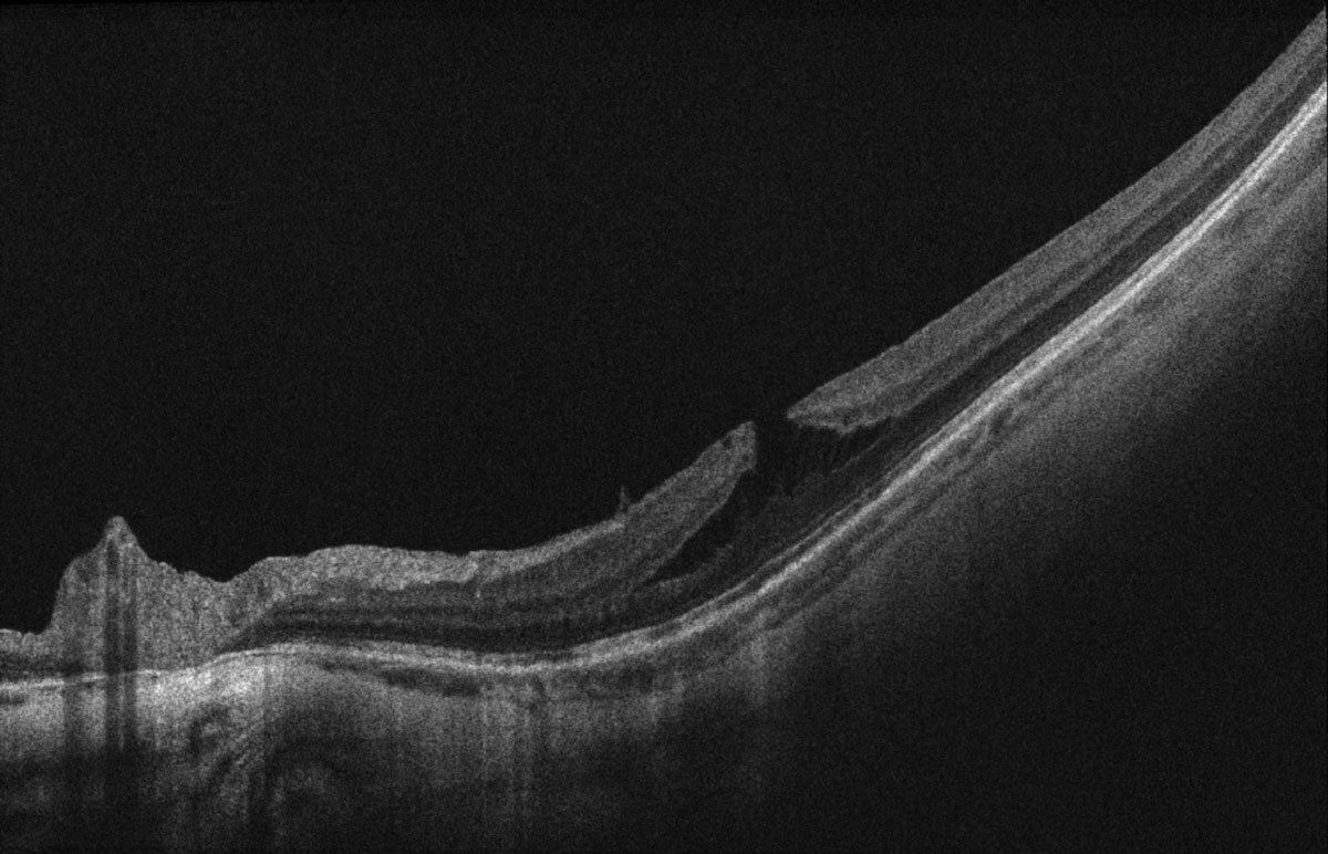 Fig 2. OCT scan of the top (A) and bottom (B) macula showing ERM, myopic foveoschisis with associated lamellar macular hole OS>OD and thin choroid.