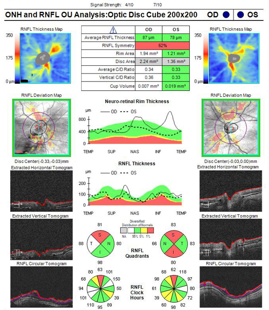 Fig 4. ONH OCT scans showing poor segmentation with PM nerves. Possible thin RNFL superior OD and superior/inferior OS.