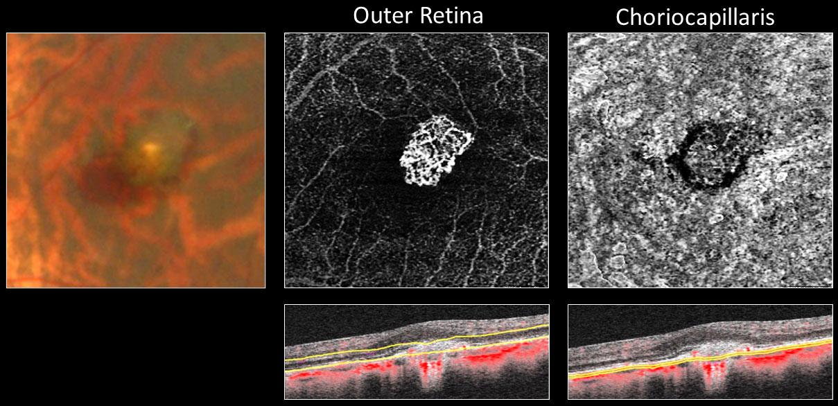 Fig 6. Fundus photo, OCT and OCT-A imaging of myopic CNV in a 44-year-old female who was -10D OU prior to LASIK.